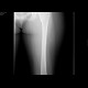Osteoid osteoma: X-ray - Plain radiograph